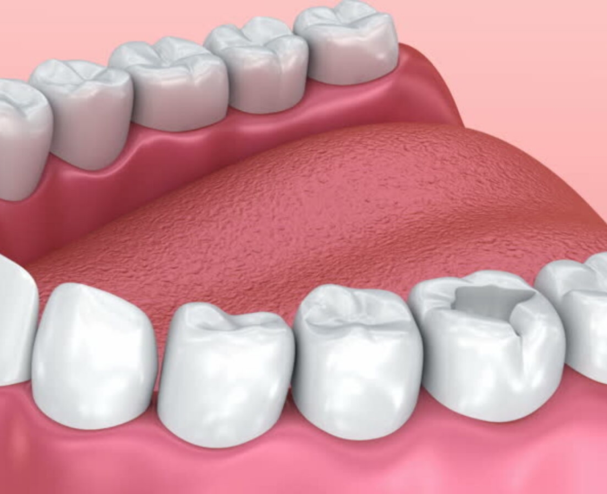 Does teeth whitening damage teeth?