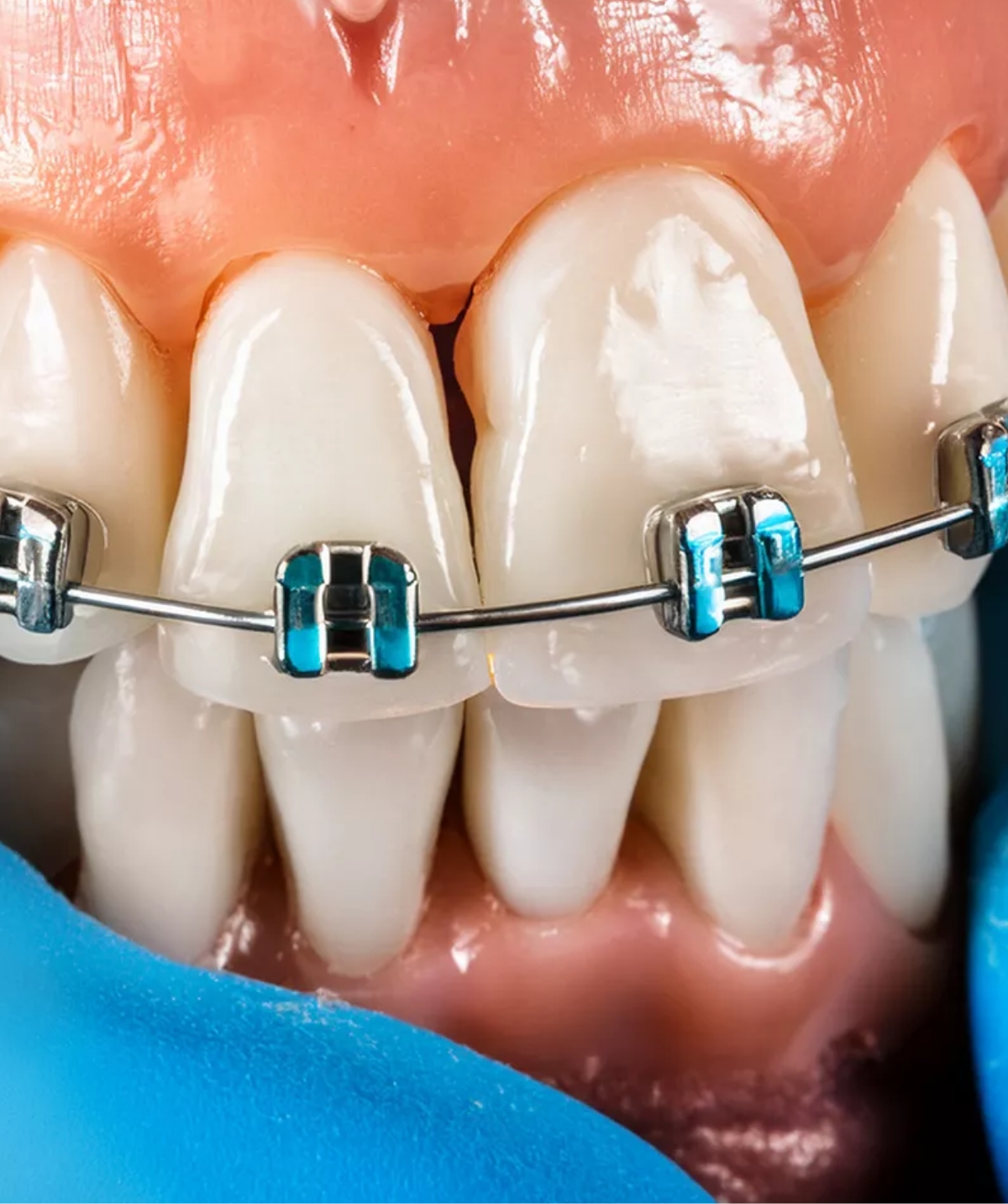 Orthodontic Treatments