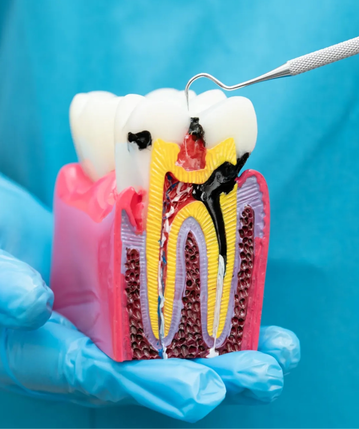 Root Canal Treatment