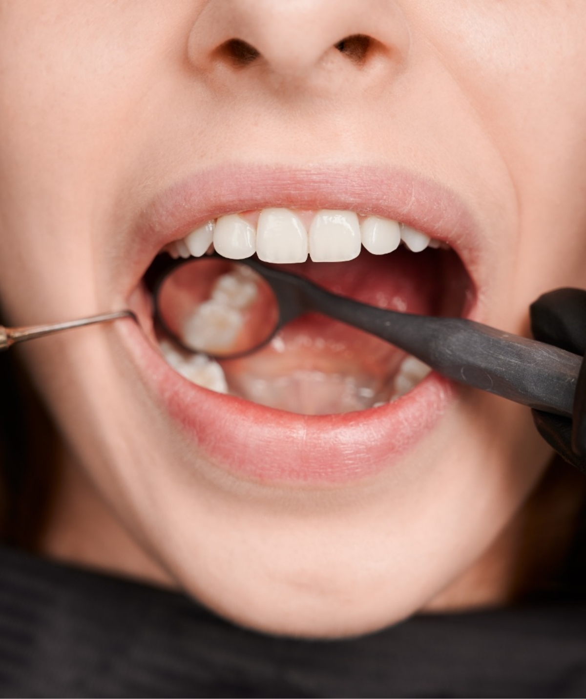 Tartar Removal & Gum Care