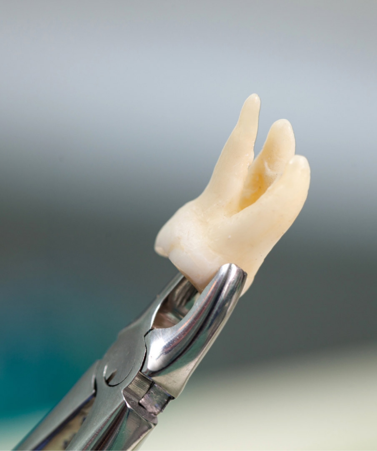 Tooth Extraction